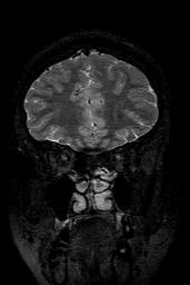 Cerebral arteriovenous malformation at posterior body of corpus callosum (Radiopaedia 74111-84925 Coronal T2 39).jpg