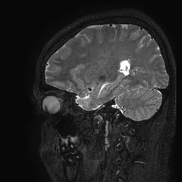 Cerebral arteriovenous malformation at posterior body of corpus callosum (Radiopaedia 74111-84925 Sagittal T2 38).jpg