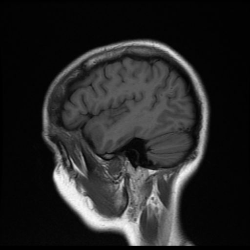 File:Cerebral autosomal dominant arteriopathy with subcortical infarcts and leukoencephalopathy (CADASIL) (Radiopaedia 41018-43768 Sagittal T1 4).png