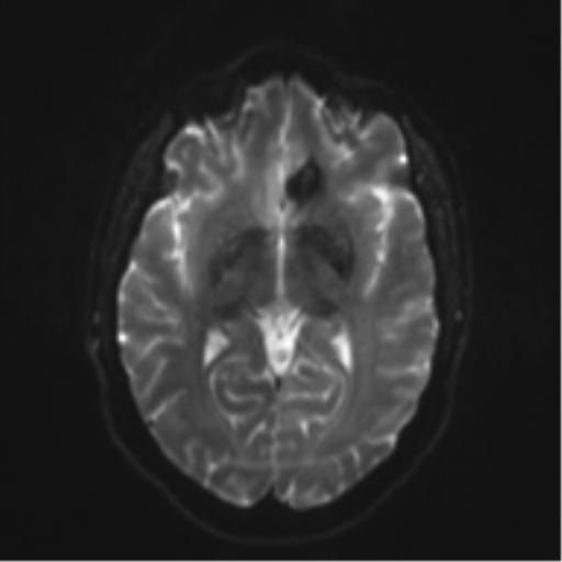 File:Cerebral cavernoma and development venous anomaly (Radiopaedia 37603-39482 Axial DWI 11).png