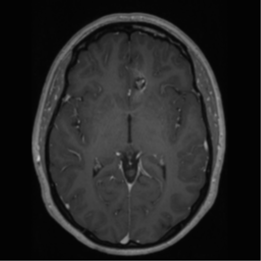 Cerebral cavernoma and development venous anomaly (Radiopaedia 37603-39482 Axial T1 C+ 37).png
