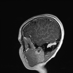 Cerebral cavernous venous malformation (Radiopaedia 70008-80021 Sagittal T1 C+ 61).jpg