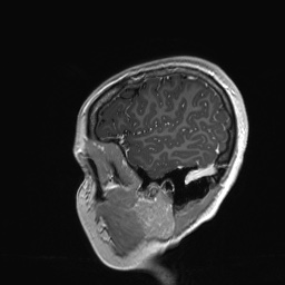 File:Cerebral cavernous venous malformation (Radiopaedia 70008-80021 Sagittal T1 C+ 62).jpg
