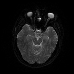 Cerebral cavernous venous malformation (Zabramski type II) (Radiopaedia 85511-101198 Axial DWI 79).jpg