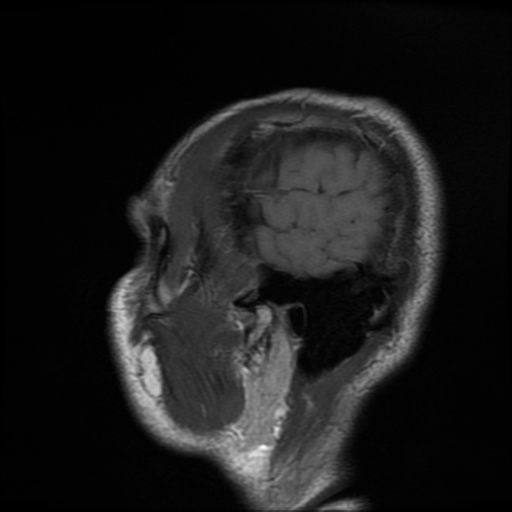 File:Cerebral cavernous venous malformation (Zabramski type II) (Radiopaedia 85511-101198 Sagittal T1 32).jpg