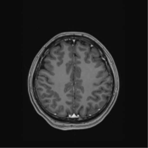 Cerebral cavernous venous malformations (Radiopaedia 48117-52946 Axial T1 C+ 46).png