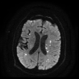 Cerebral embolic infarcts (embolic shower) (Radiopaedia 49837-55108 Axial DWI 67).jpg