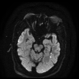 Cerebral embolic infarcts (embolic shower) (Radiopaedia 49837-55108 Axial DWI 79).jpg