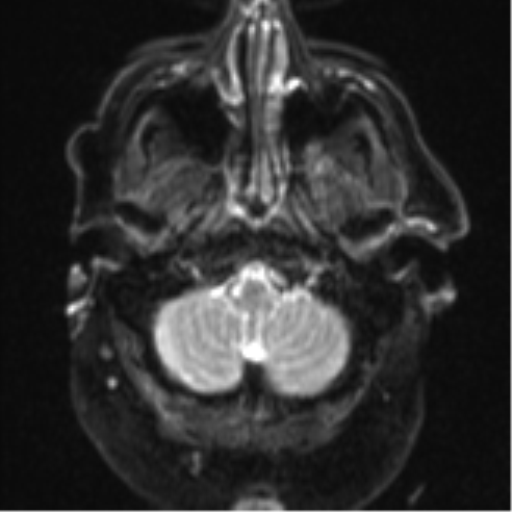 Cerebral embolic infarcts (embolic shower) (Radiopaedia 57395-64342 Axial DWI 5).png