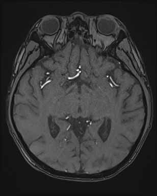 Cerebral embolic infarcts (embolic shower) (Radiopaedia 72391-82921 Axial MRA 76).jpg