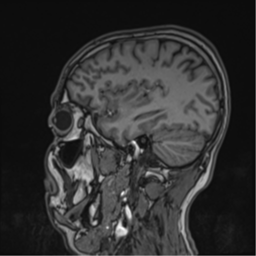 Cerebral fat embolism (Radiopaedia 57697-64639 Sagittal T1 18).png