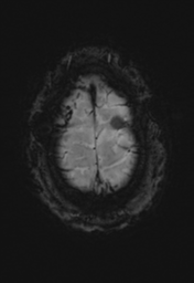 File:Cerebral hemorrhagic contusions- temporal evolution (Radiopaedia 40224-42757 D 37).png