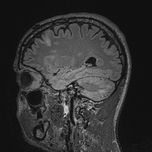 File:Cerebral hemorrhagic contusions- temporal evolution (Radiopaedia 40224-42757 Sagittal T1 27).png