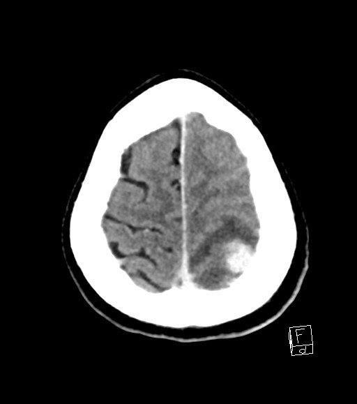 Cerebral metastases - testicular choriocarcinoma (Radiopaedia 84486-99855 Axial C+ delayed 11).jpg