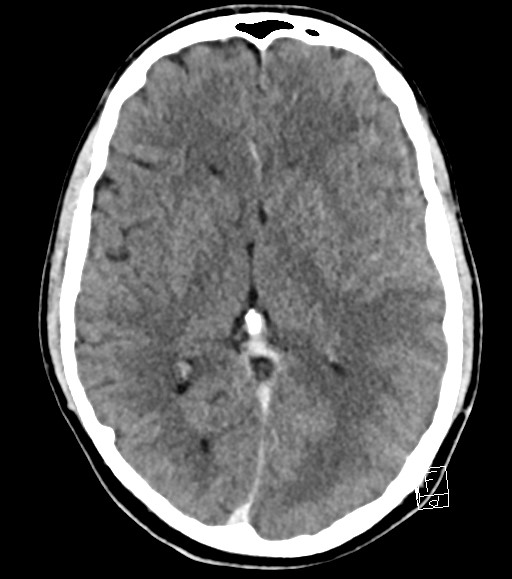 Cerebral metastases - testicular choriocarcinoma (Radiopaedia 84486-99855 Axial C+ delayed 30).jpg