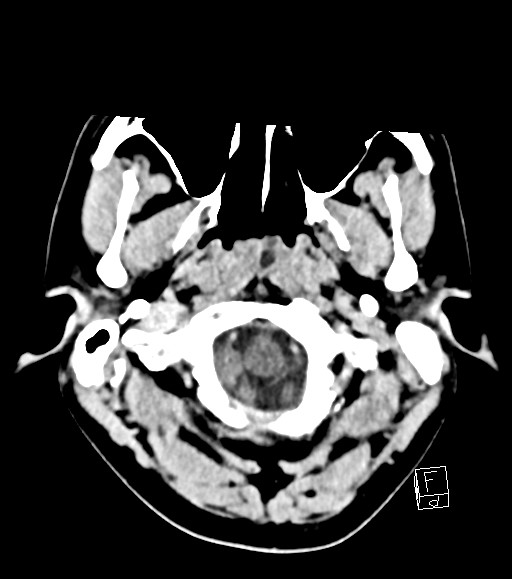 Cerebral metastases - testicular choriocarcinoma (Radiopaedia 84486-99855 Axial C+ delayed 50).jpg