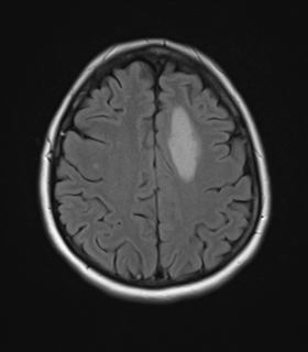 File:Cerebral metastases mimicking abscesses (Radiopaedia 45841-50131 Axial FLAIR 21).png