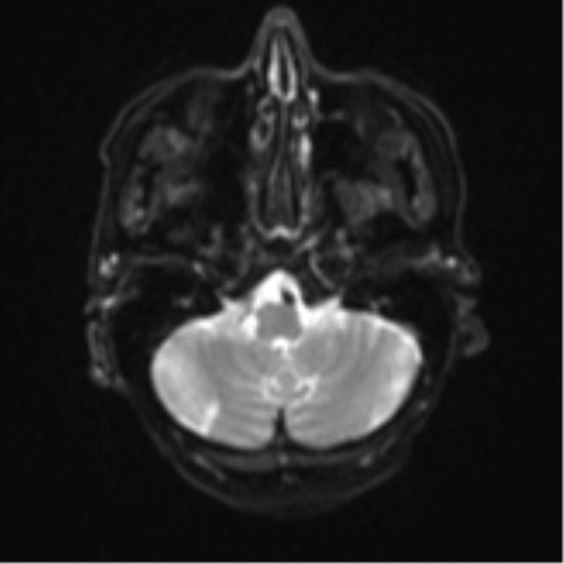 File:Cerebral metastasis (Radiopaedia 46744-51248 Axial DWI 5).png