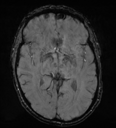 Cerebral metastasis - melanoma (Radiopaedia 54718-60954 Axial SWI 26).png