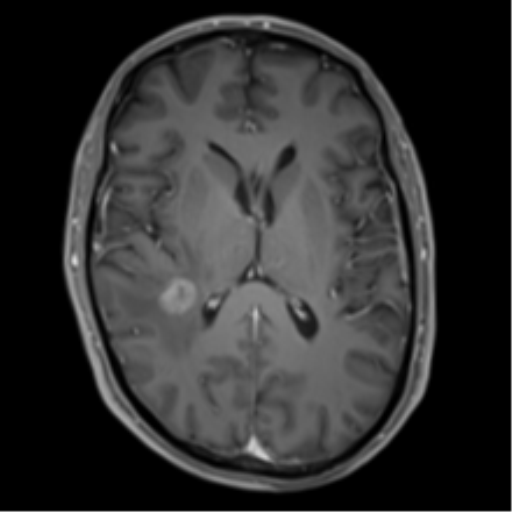 Cerebral metastasis - melanoma (Radiopaedia 54718-60954 Axial T1 C+ fat sat 29).png