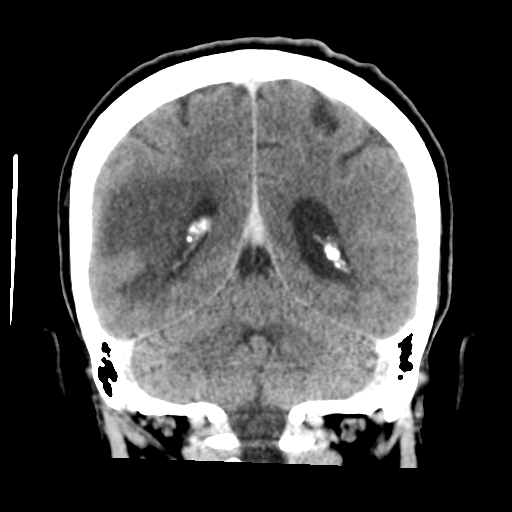 Cerebral metastasis to basal ganglia (Radiopaedia 81568-95412 Coronal C+ delayed 43).png