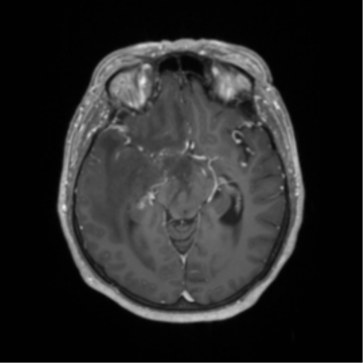 Cerebral metastasis to basal ganglia (Radiopaedia 81568-95413 Axial T1 C+ 30).png