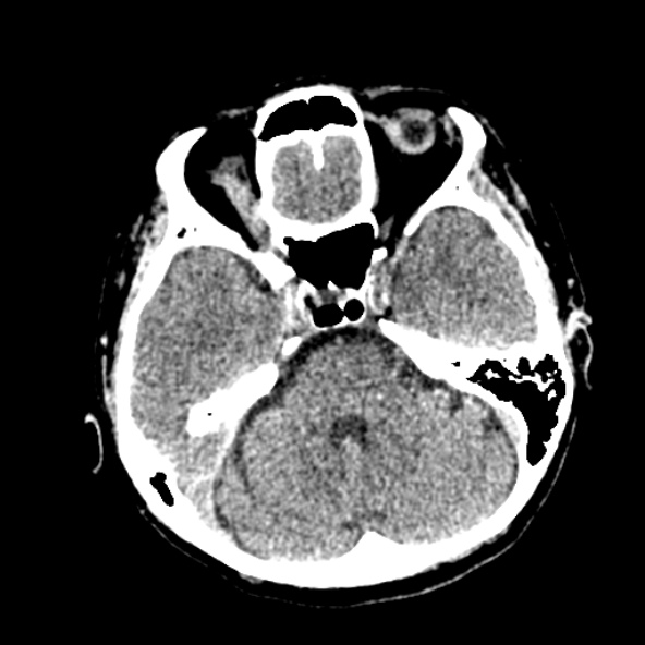 Cerebral ring enhancing lesions - cerebral metastases (Radiopaedia 44922-48818 Axial non-contrast 35).jpg