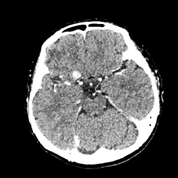 Cerebral ring enhancing lesions - cerebral metastases (Radiopaedia 44922-48818 B 108).jpg