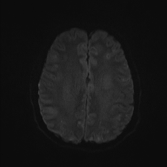 Cerebral toxoplasmosis (Radiopaedia 53993-60132 Axial DWI 45).jpg