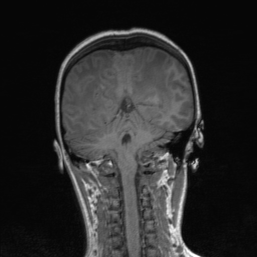 Cerebral tuberculosis with dural sinus invasion (Radiopaedia 60353-68090 Coronal T1 129).jpg