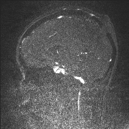 Cerebral tuberculosis with dural sinus invasion (Radiopaedia 60353-68090 Sagittal MRV 83).jpg