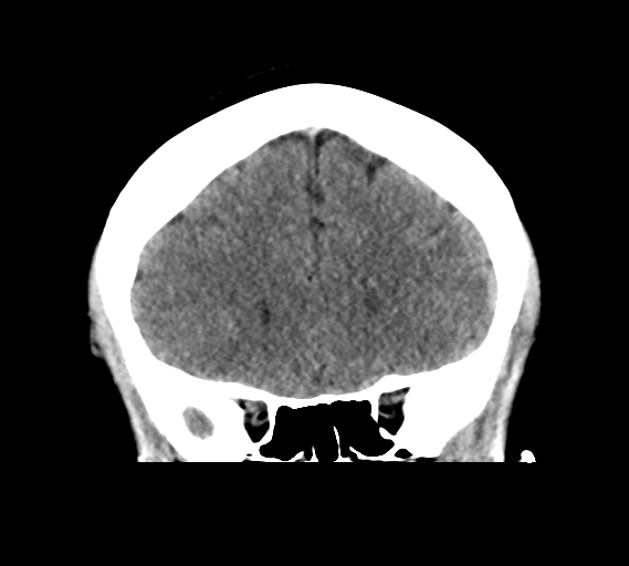 File:Cerebral venous infarct related to dural venous sinus thromboses (Radiopaedia 35292-36804 Coronal non-contrast 11).png