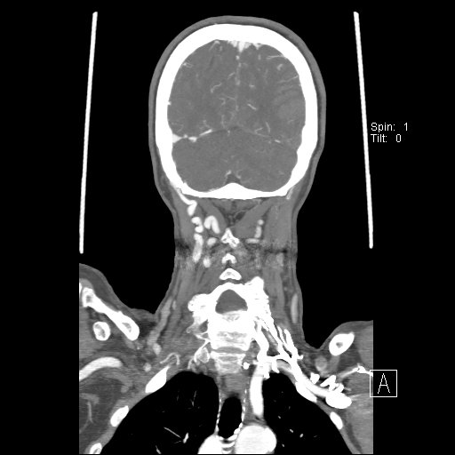 Cerebral venous infarction with hemorrhage (Radiopaedia 65343-74396 B 221).jpg