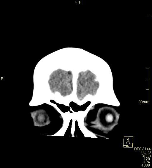 Cerebral venous sinus thrombosis (Radiopaedia 91329-108965 Coronal non-contrast 5).jpg