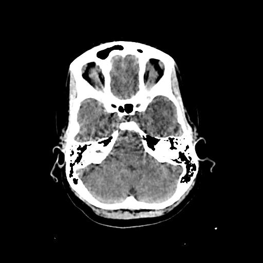 Cerebral venous throbmosis - hemorrhagic venous infarction (Radiopaedia 87318-103613 Axial non-contrast 38).jpg