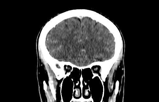 Cerebral venous thrombosis (CVT) (Radiopaedia 77524-89685 C 16).jpg