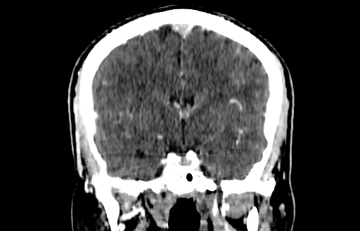 File:Cerebral venous thrombosis (CVT) (Radiopaedia 77524-89685 C 29).jpg