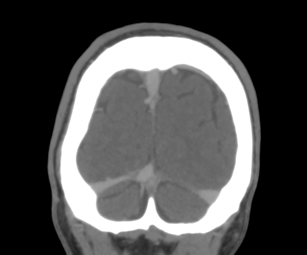 Cerebral venous thrombosis (Radiopaedia 38392-40467 Coronal CTA-Venogram 55).png