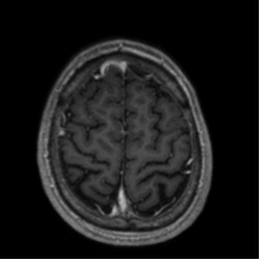 Cerebral venous thrombosis (Radiopaedia 38392-40469 Axial T1 C+ 66).png