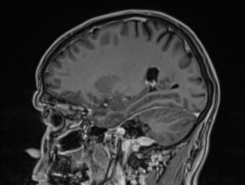 Cerebral venous thrombosis (Radiopaedia 71207-81504 Sagittal T1 C+ 42).jpg
