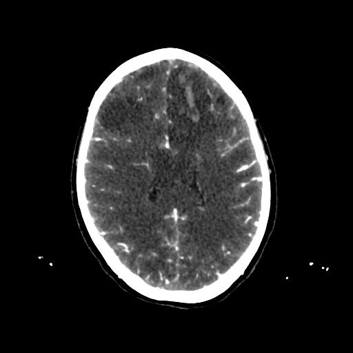 File:Cerebral venous thrombosis - hemorrhagic venous infarction (Radiopaedia 87318-103613 Axial 220).jpg