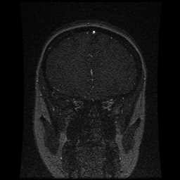 Cerebral venous thrombosis - ulcerative colitis (Radiopaedia 66049-75219 Coronal MRV 86).jpg