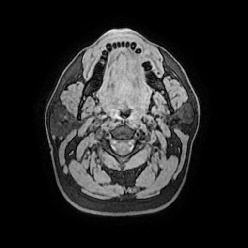 File:Cerebral venous thrombosis with secondary intracranial hypertension (Radiopaedia 89842-106957 Axial T1 1).jpg