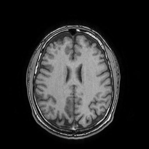Cerebral venous thrombosis with secondary intracranial hypertension (Radiopaedia 89842-106957 Axial T1 115).jpg