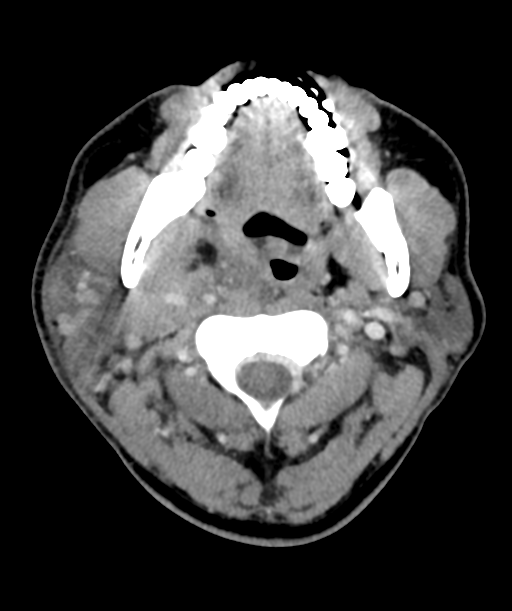Cervical abscess (Radiopaedia 43725-47184 A 20).png