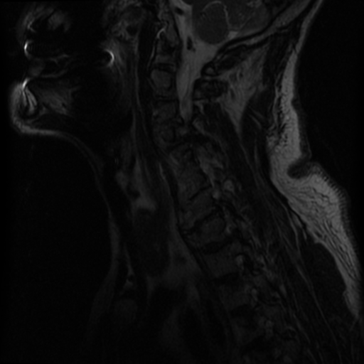 File:Cervical canal stenosis with cord compression (Radiopaedia 34114-35374 Sagittal T2 10).png