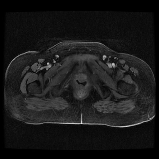 Cervical carcinoma (Radiopaedia 70924-81132 Axial T1 C+ fat sat 202).jpg