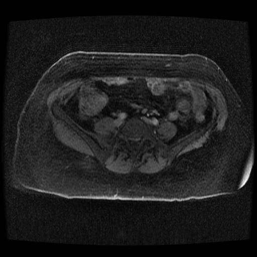 Cervical carcinoma (Radiopaedia 70924-81132 Axial T1 C+ fat sat 259).jpg