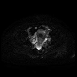 Cervical carcinoma (Radiopaedia 85405-101028 Axial DWI 31).jpg