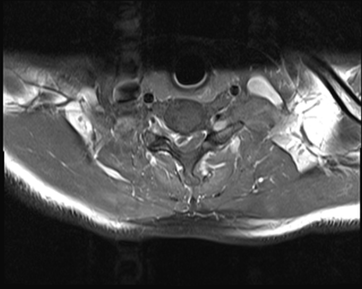 File:Cervical disc extrusion (Radiopaedia 53950-60077 Axial T1 C+ fat sat 20).jpg